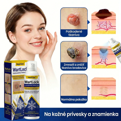 𝑺𝒄𝒉𝒗á𝒍𝒆𝒏é 𝒂𝒈𝒆𝒏𝒕ú𝒓𝒐𝒖 𝑻𝑮𝑨 🚀 | Healrize® WartLock Kryoterapeutický Chladivý Sprej 🚀